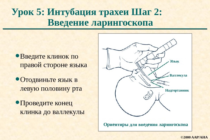 Интубация трахеи презентация