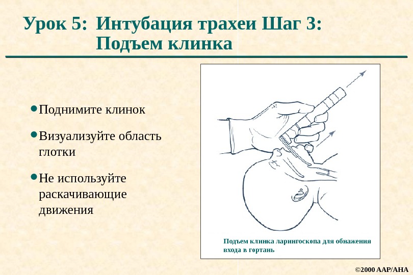 Интубация трахеи картинки