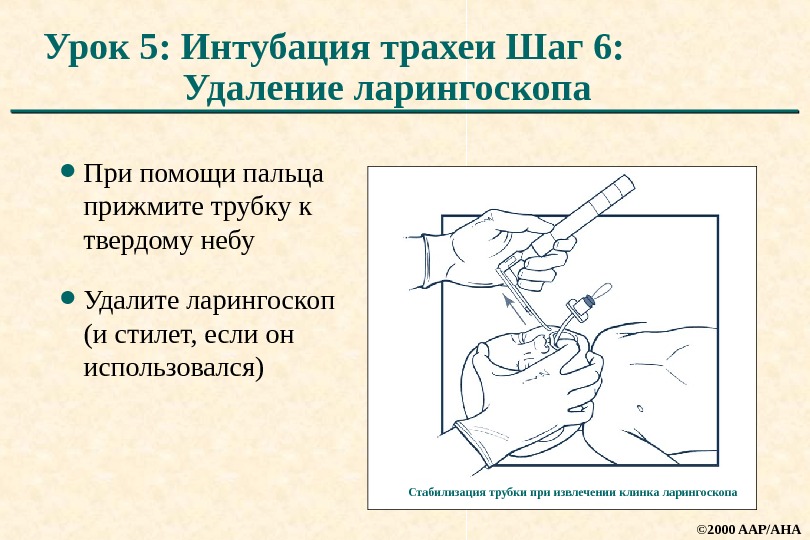 Интубация трахеи презентация