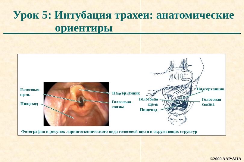 Интубация трахеи картинки