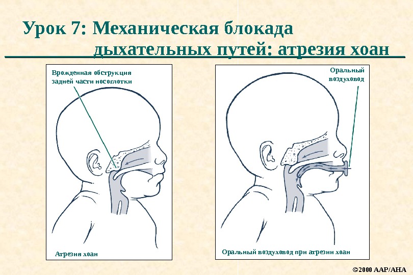 Атрезия хоан презентация