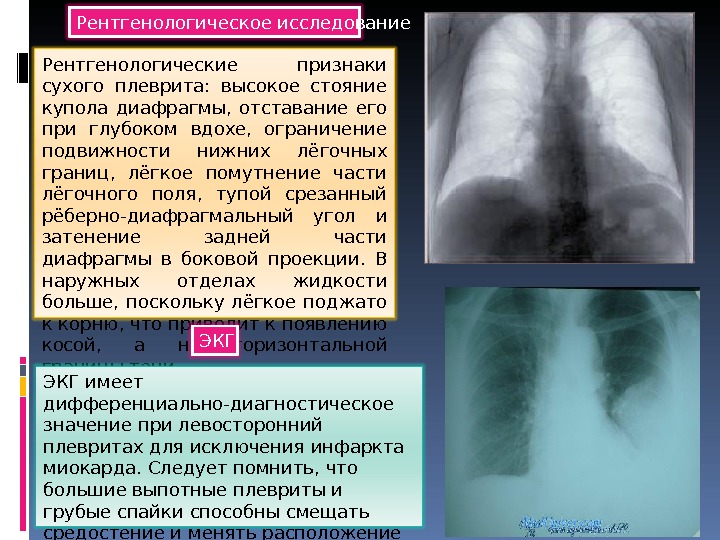 Последствия легкого. Констриктивный плеврит. Рентгенологическое исследование при Сухом плеврите. Плеврит симптомы.
