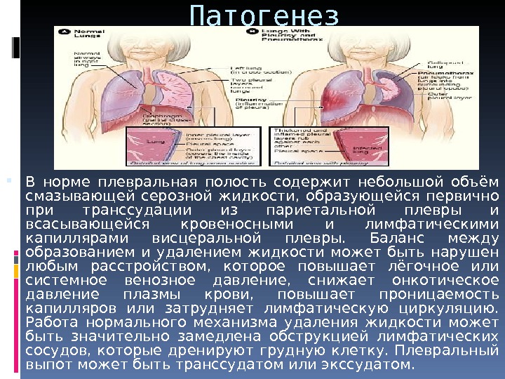 Жидкость в плевральной полости. Норма жидкости в плевральной полости. Норма плеврального выпота. Плевральный выпот транссудат. В норме плевральная полость содержит жидкость.