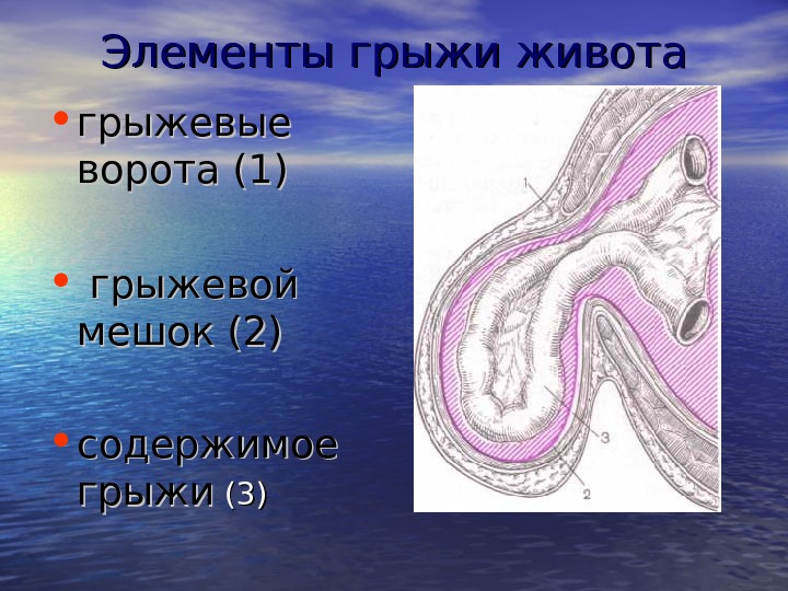 Наружные и внутренние грыжи живота презентация