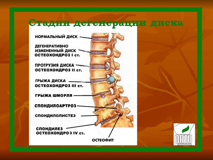Остеохондроз позвоночника презентация