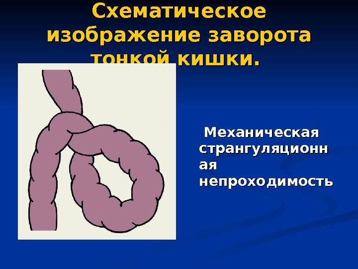 Кишечная непроходимость. Странгуляционная тонкокишечная непроходимость. Кишечная непроходимость заворот. Непроходимость тонкого кишечника.