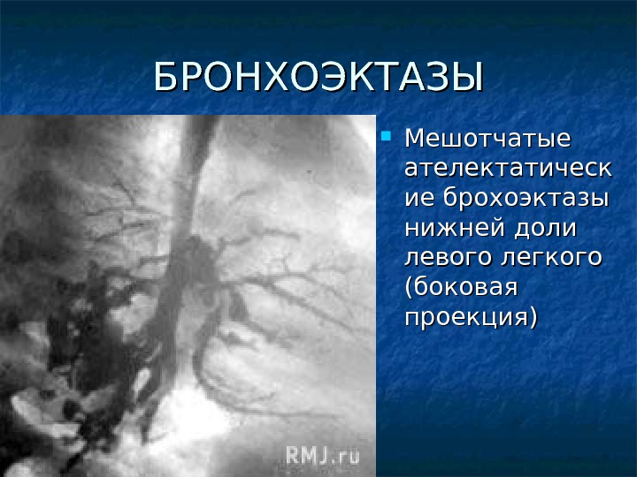 Мешотчатые бронхоэктазы на кт в легких. Мешотчатые бронхоэктазы на бронхографии. Мешотчатые бронхоэктазы это расширение. Бронхоэктазы на снимке. Мешотчатые бронхоэктазы.