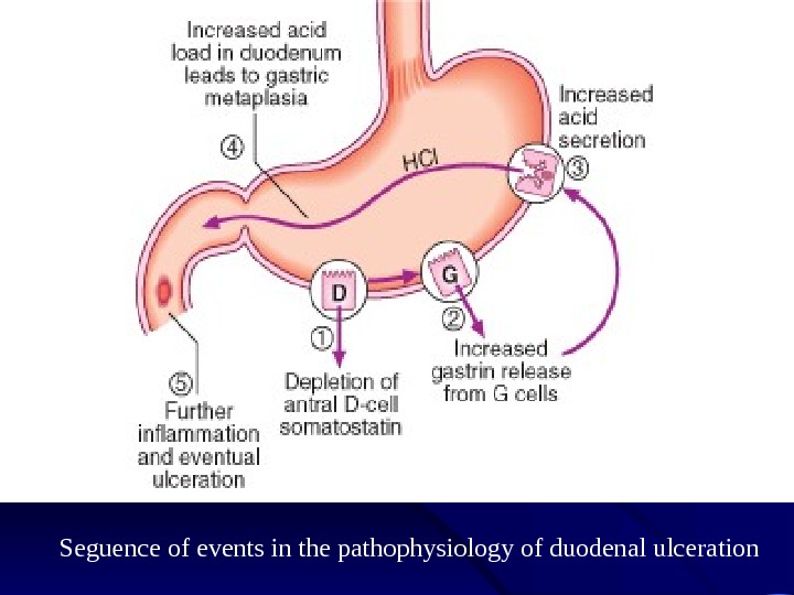 Peptic Ulcer Disease Pathophysiology