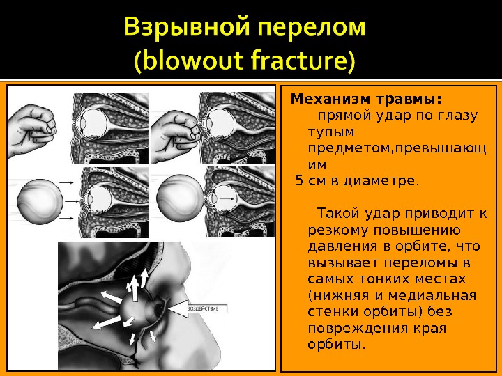 Для закрытого перелома костного края нижней стенки глазницы наиболее характерен