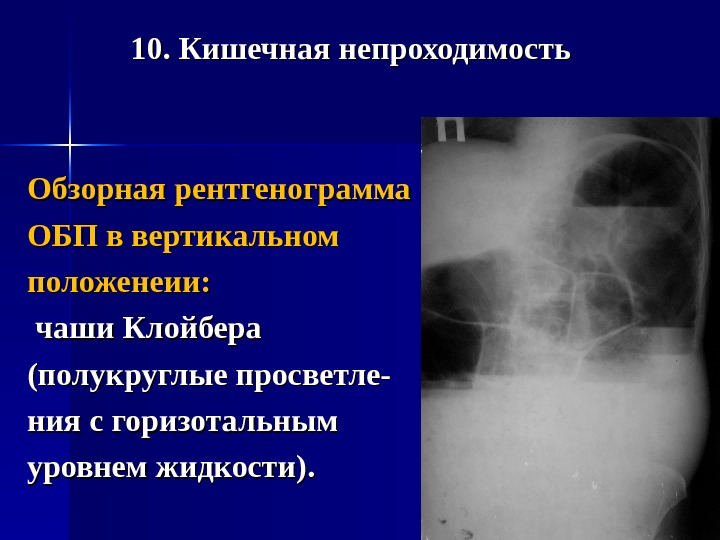 Кишечная непроходимость рентген. Кишечная непроходимость рентген чаши Клойбера. Кишечная непроходимость чаши Клойбера. Инвагинационная кишечная непроходимость рентген. Паралитическая кишечная непроходимость рентген.