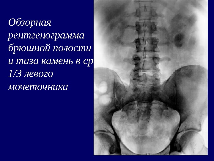 Рентгенография органов брюшной полости. Обзорная рентгенография брюшной полости норма. Обзорный снимок брюшной полости. Обзорная рентгенограмма брюшной полости. Обзорный снимок органов брюшной полости.