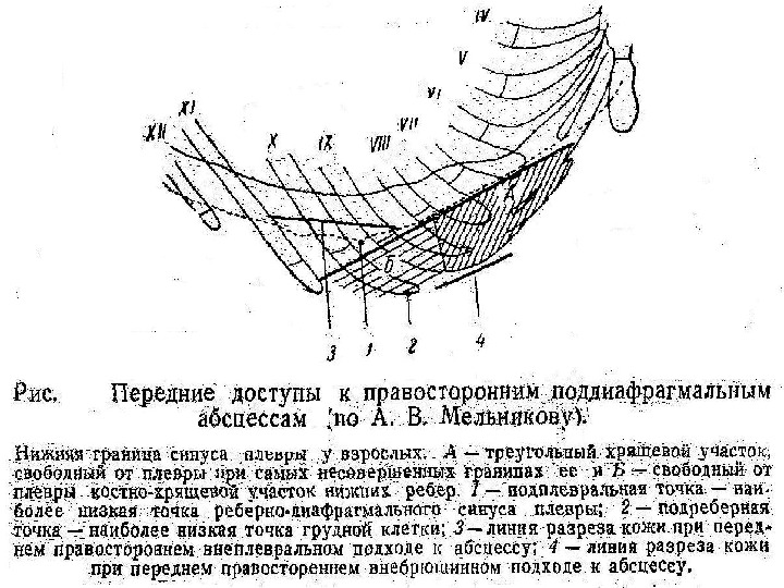 Презентация Поддиафрагмальный абсцесс