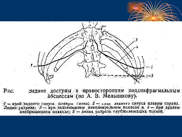 Презентация Поддиафрагмальный абсцесс