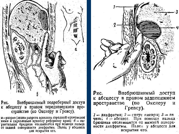 Как отличить абсцесс