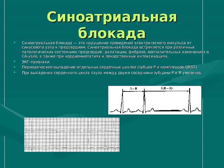 Признаки синоатриальной блокады. Синоатриальная блокада 3 степени на ЭКГ. Синоатриальная блокада на ЭКГ признаки. ЭКГ признаки синоатриальной блокады. Са блокада 2 степени 2 типа.