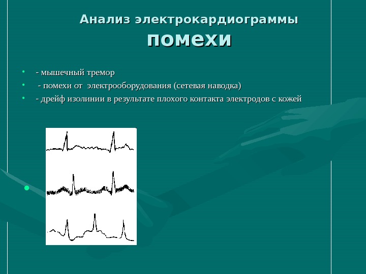 Дрейф изолинии на экг что это