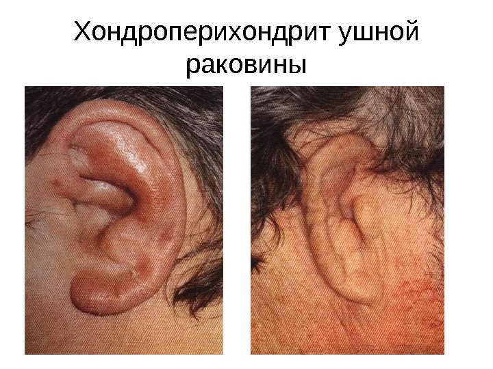 Презентация презентация лекций — Лекция 1 — наружный и средний отит