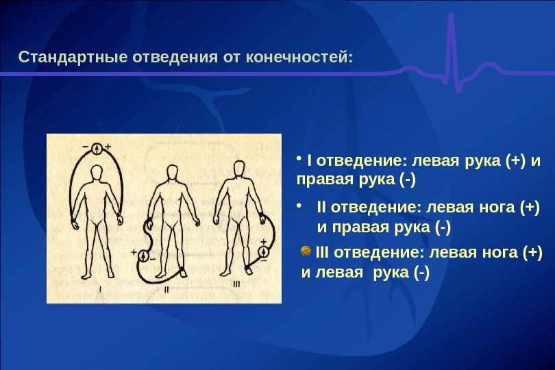 Левая нога левая рука. Стандартные отведения от конечностей. Стандартные отведения и отведения от конечностей. Первое стандартное отведение от конечностей. Усиленные отведения конечностей.