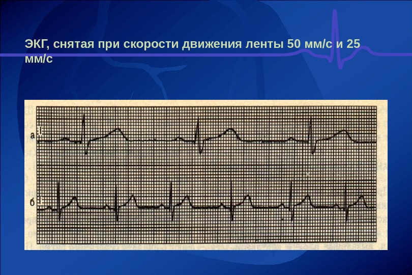 Экг рейтинг. Скорость записи ЭКГ 50 мм с. Скорость записи 50 мм в сек ЭКГ. ЭКГ скорость 25 мм/с. Скорость записи ЭКГ 25 мм с.