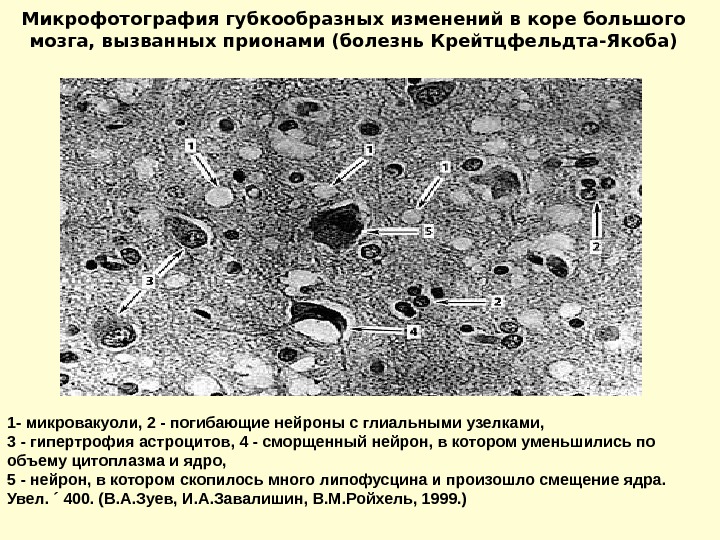 Прионные болезни презентация