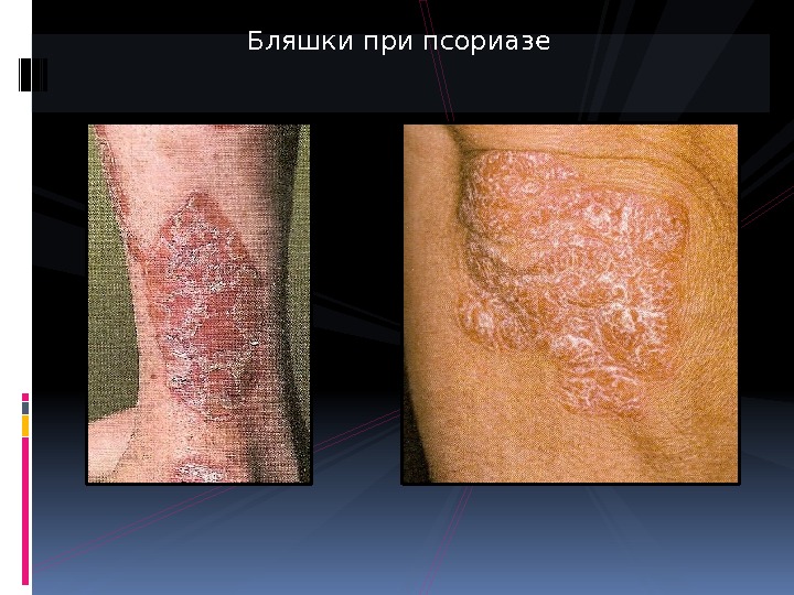 Seborrhiasis Презентация псориаз