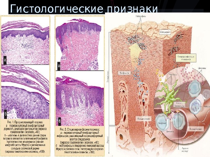 Клиническая картина псориаза