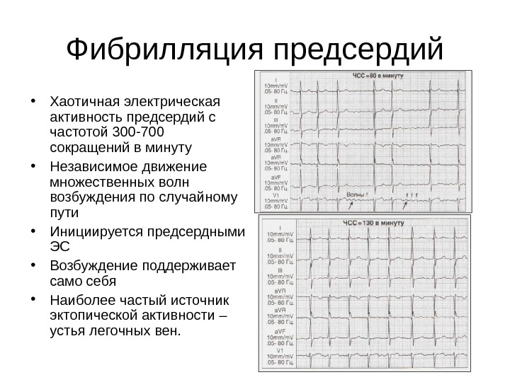 Фибрилляция предсердий презентация