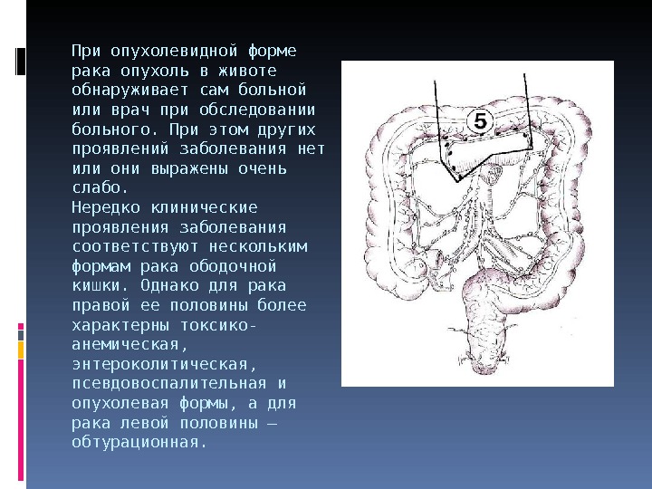 Рак ободочной кишки презентация