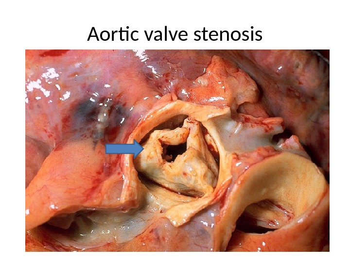 Rheumatic endocarditis RHEUMATIC HEART DISEASE