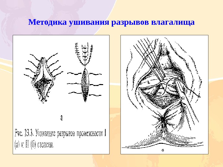 Родовой травматизм матери и плода презентации