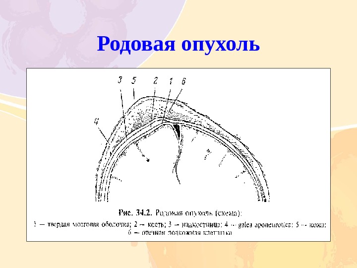 Родовой травматизм матери и плода презентации