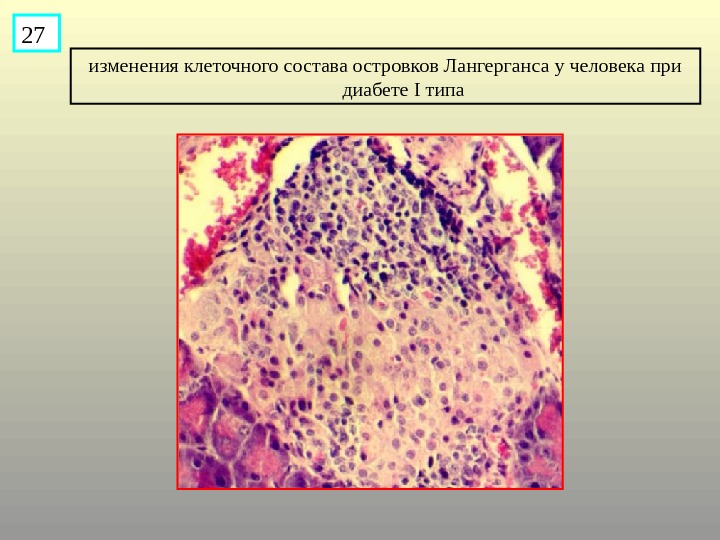 Изменения клетки. Гистология островки Лангерганса диабет 2. Клеточный состав островков Лангерганса. Островки Лангерганса патанатомия. Амилоидоз островков Лангерганса препарат.
