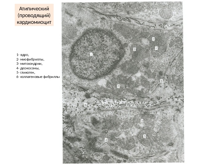 Атипичные кардиомиоциты рисунок