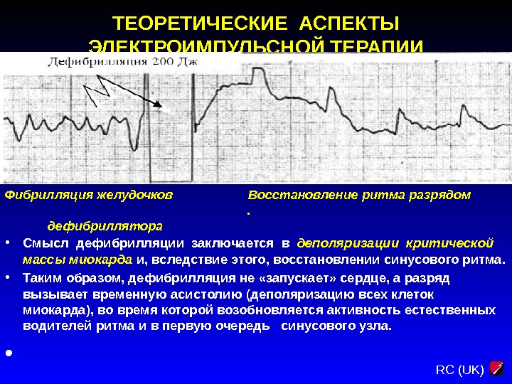 Ритм восстанавливается. Электроимпульсная терапия при нарушениях сердечного ритма. Разряд дефибриллятора на ЭКГ. Нарушения сердечного ритма, требующие дефибрилляции. Дефибрилляция для восстановления сердечного ритма.