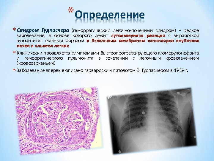 Синдром гудпасчера презентация