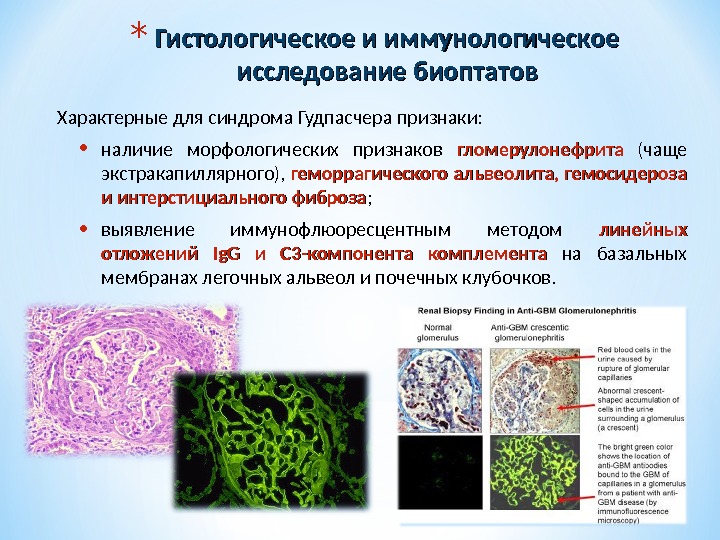 Синдром гудпасчера презентация