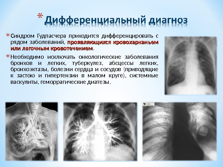 Синдром гудпасчера презентация