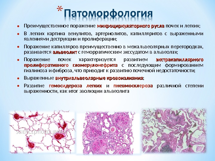 Синдром гудпасчера презентация