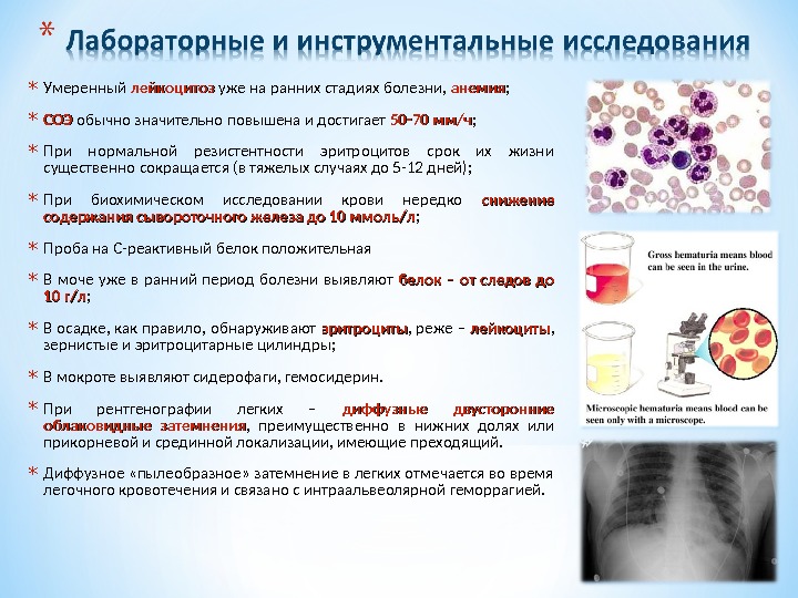 Синдром гудпасчера презентация