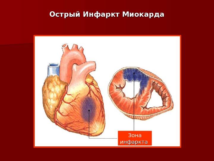 Инфаркт на картинке