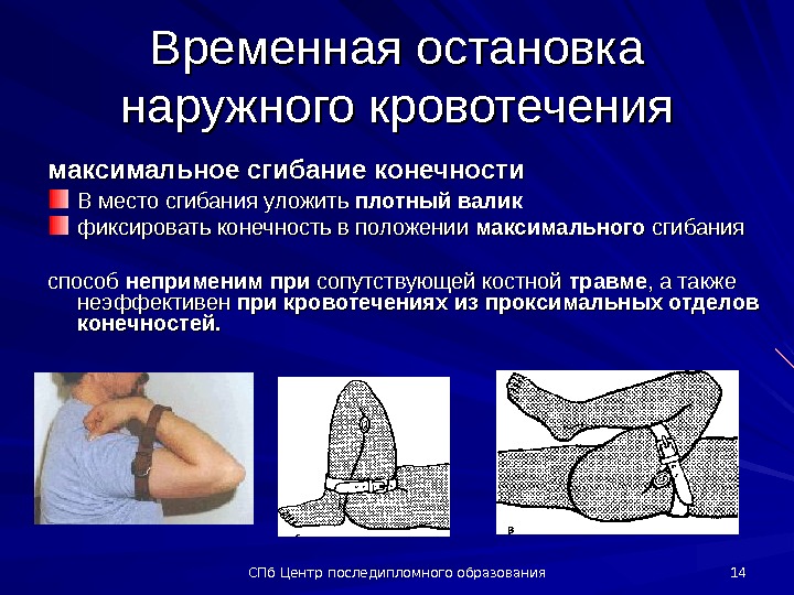 Временные способы остановки наружного кровотечения. Максимальное сгибание конечности осложнения. Остановка кровотечения методом максимального сгибания конечности. Остановке наружного кровотечения способом максимального сгибания. Форсированное сгибание конечности при кровотечении.