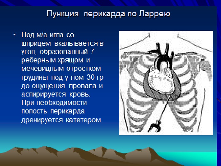 Полость перикарда. Пункция полости перикарда. Точки пункции перикарда. Точка Ларрея для пункции перикарда. Технику пункции перикарда по Ларрею.