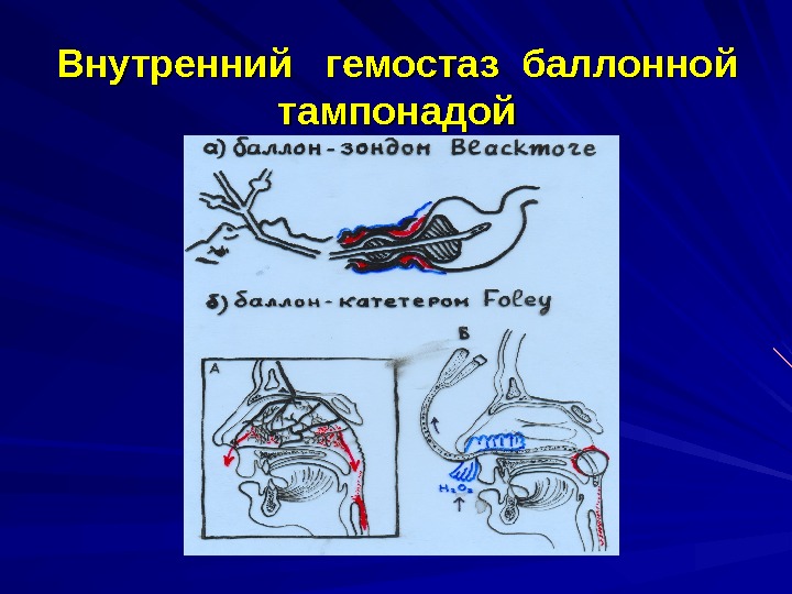 Баллонная тампонада матки презентация