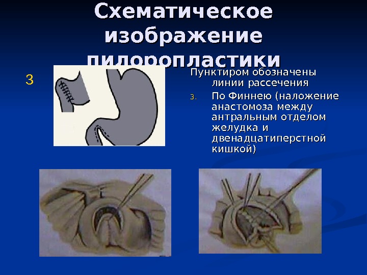 Пилоропластика по финнею схема