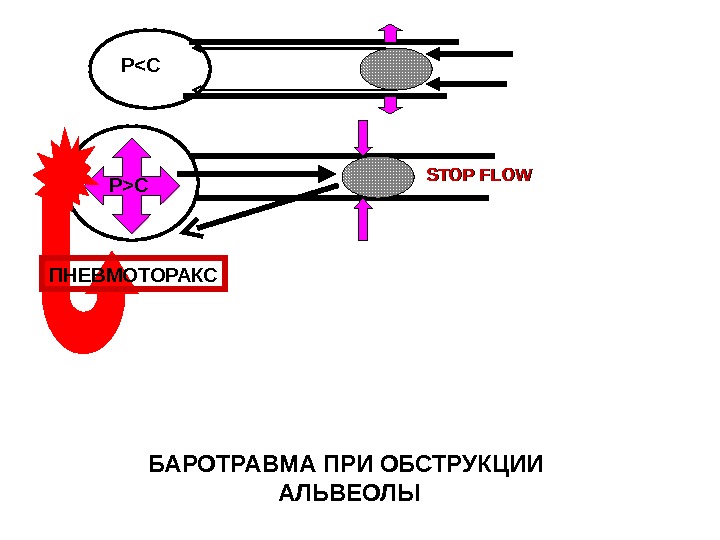 Схема на базе ппвм баротравма