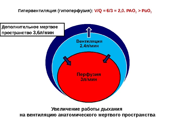 Гипоперфузия нижней стенки лж