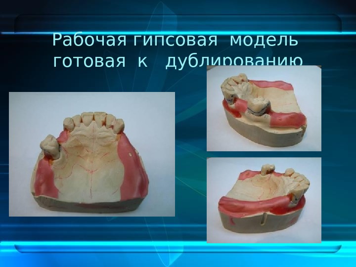 Нанесение рисунка каркаса бюгельного протеза на модель