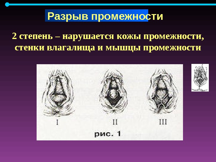 Перинеотомия и эпизиотомия презентация