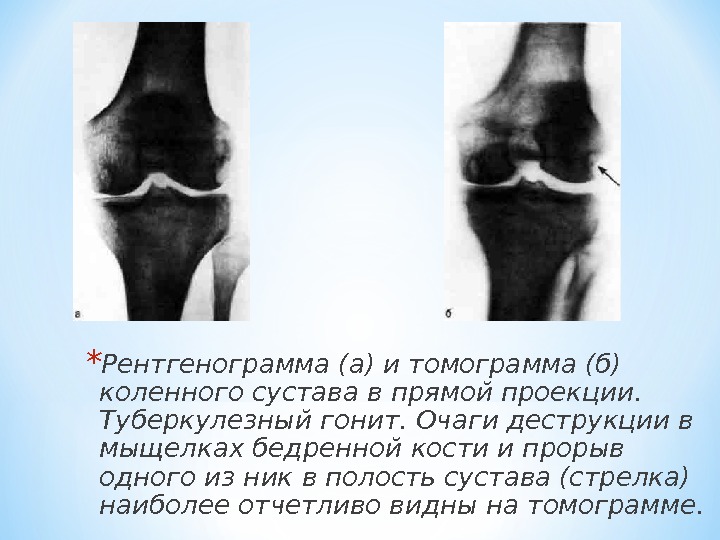 Коленный туберкулез. Гемартроз коленного сустава рентген. Рентген коленного сустава в прямой проекции. Гемартроз коленного сустава рентген описание. Туберкулез коленного сустава 2-я стадия.