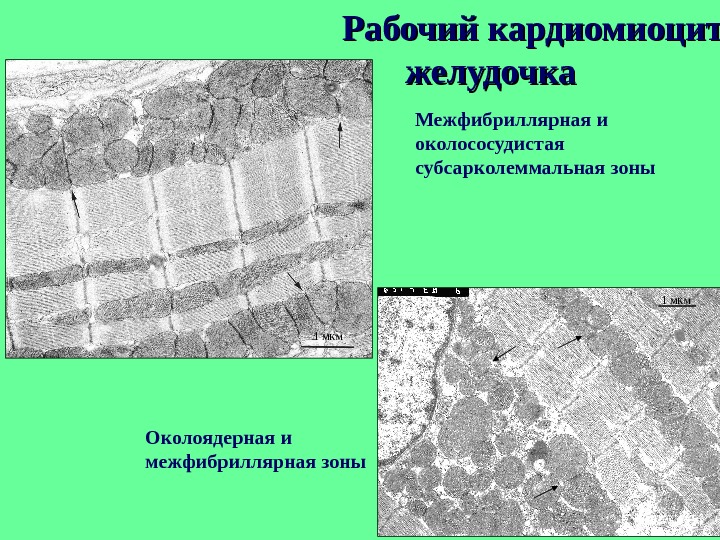 Атипичные кардиомиоциты рисунок